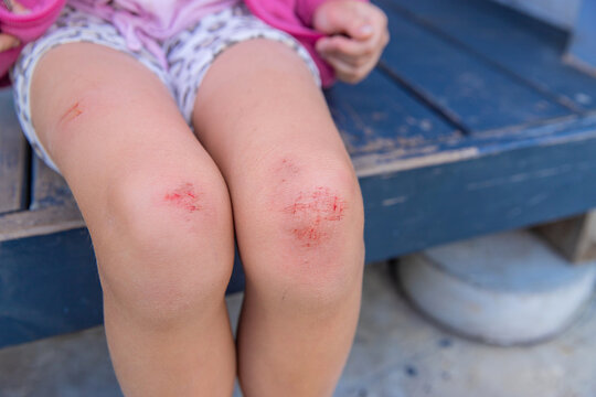 The child has scrapes on his knees. Selective focus.