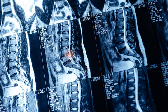 Multiple mri lumbar spine scan series of man adult for medical diagnostic background