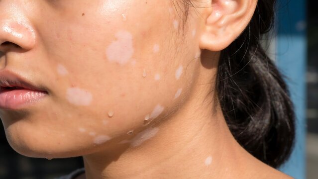 Woman displays vitiligo patches on her face and neck highlighting skin pigment differences.