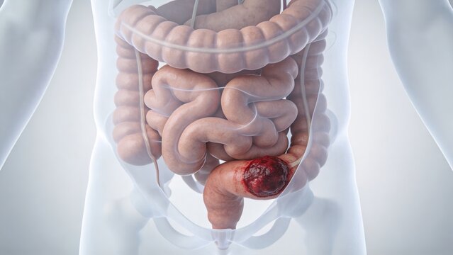 Colorectal Cancer: Malignant Tumor Lesion of Human Colon Rectum, 3D Medical Anatomical Illustration of Large Intestine