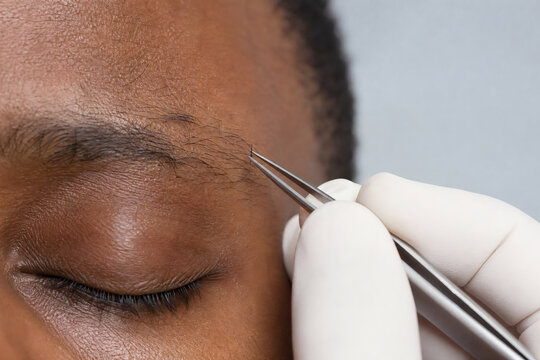 Eyebrow Transplantation in Dark Skin Patient with Single Hair Graft Placement at the Tail of the Eyebrow