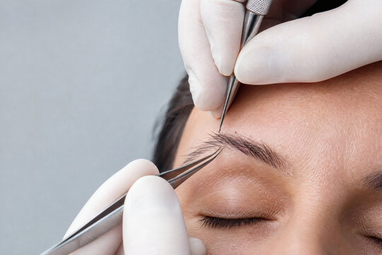 Eyebrow Transplant Surgery &ndash; Placement of Single-Hair Grafts with Fine Forceps