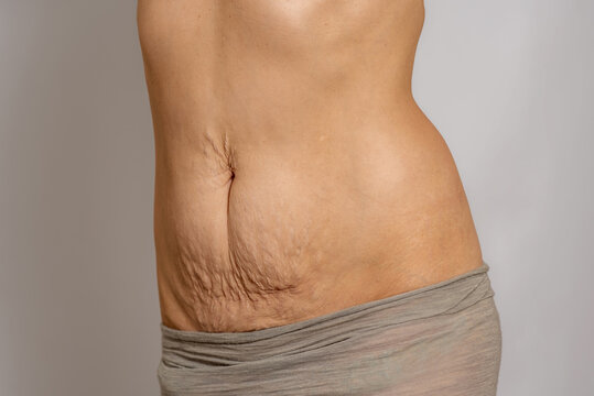 Woman postpartum belly with loose skin and stretch marks after pregnancy
