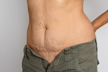Naklejka premium Side view of woman's stomach with excess loose skin and stretch marks after childbirth, body imperfection and weight loss result