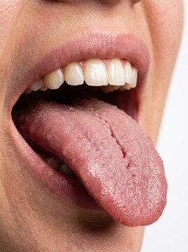 Detailed Macro View of a Human Tongue Showing Fissures, Papillae, and Oral Anatomy