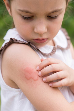 Close up of a little girl examining and scratching a red swollen insect bite or allergic skin reaction on her arm outdoors