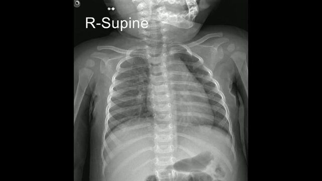 Supine anteroposterior chest radiograph of a neonate video 