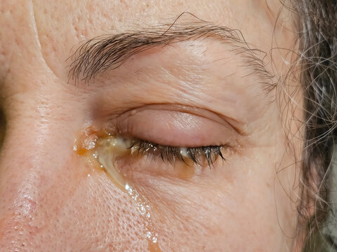 Close-up of human eye with discharge and eyelid inflammation. conjunctivitis in adenovirus infection