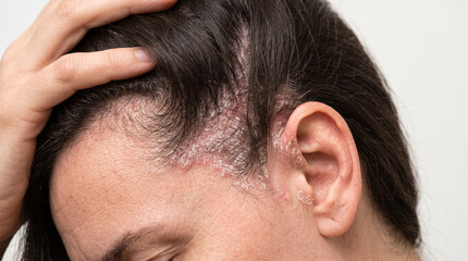 Fototapeta premium Close-Up of Scalp Psoriasis and Plaque Lesions Around Ear and Hairline During Medical Examination