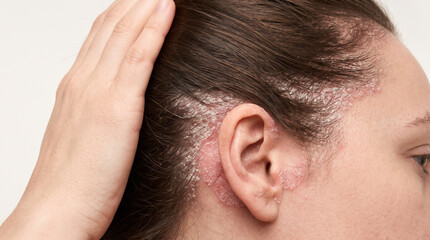 Fototapeta premium Clinical Macro-Photograph of Scalp Psoriasis and Plaque Lesions Around the Ear and Hairline During a Dermatological Examination
