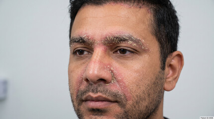 Fototapeta premium Close-Up of Facial Seborrheic Dermatitis Showing Redness and Flaking Scaling Patches Around Eyebrows and Nose