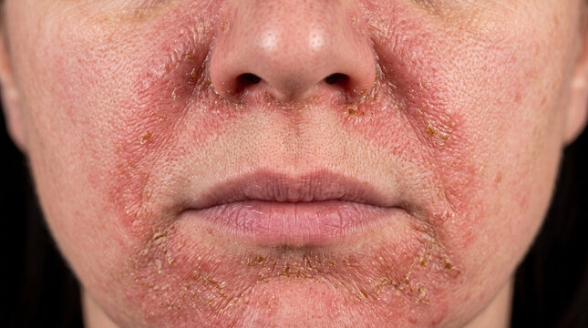 Macro Close-Up of Severe Facial Seborrheic Dermatitis: Red Inflamed Skin with Heavy Scaling Near Nose and Chin