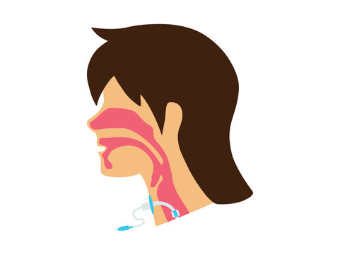 Tracheostomy Tube or Throat Cancer Airway