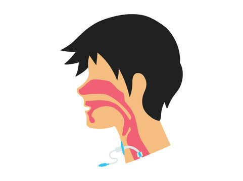 Tracheostomy Tube or Throat Cancer Airway