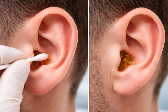 Close up of earwax removal with cotton swab before and after cleaning treatment
