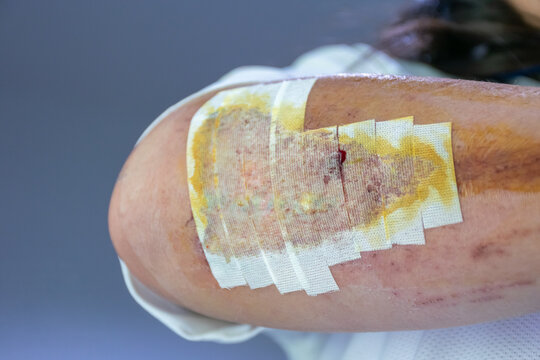Close view of an injured arm covered medical gauze adhesive tape bruising small blood spot during wound care recovery
