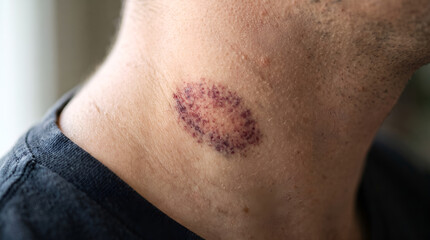 Naklejka premium Close up of a prominent purple Hickey on a male neck
