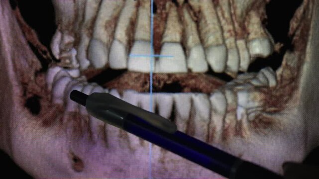 Three dimensional dental CBCT reconstruction displayed on a computer monitor with a dentist pointing to the lower jaw using a pen. Digital imaging used for implant planning and dental diagnosis.