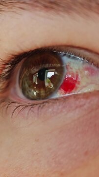 Close up of a human eye with a subconjunctival hemorrhage