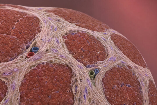 Liver Fibrosis Close Up With Collagen Scarring