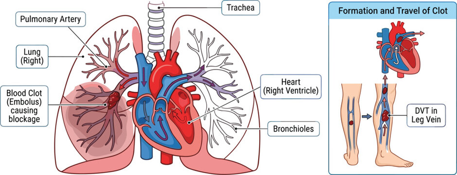 Pulmonary Embolism and Deep Vein Thrombosis Medical Infographic Diagram for Healthcare Education and Textbook Illustrations