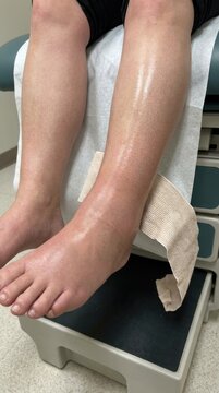 Swelling human leg: joint inflammation, fluid retention, ankle edema, medical bandage, tissue expansion, unwell patient, physical injury, skin tension, care facility.