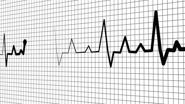 Heartbeat line on graph paper showing an irregular ecg pattern with a flatline section animation