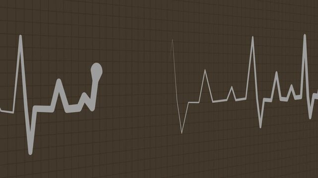 Heartbeat line on graph paper showing an irregular ecg pattern with a flatline section animation