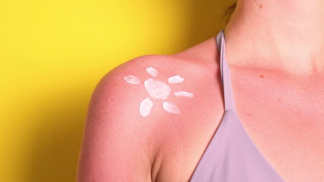 Close up of sunburned skin with severe redness and sunscreen cream applied to shoulder, UV damage concept