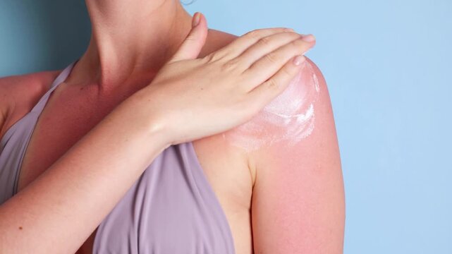 Close up of sunburned skin with severe redness and sunscreen cream applied to shoulder, UV damage concept