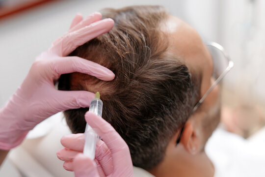 Trichologist Medical scalp injection for hair restoration at clinic for treatment and dermatology patient care