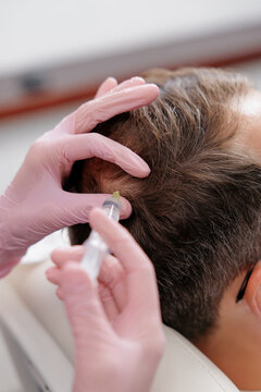 Closeup scalp injection hair restoration treatment for men in clinic for medical trichologist