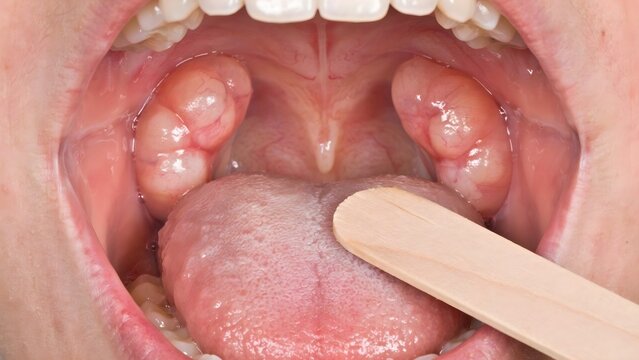 Close-up view of inflamed tonsils and uvula inside a human mouth, indicating a sore throat or infection.