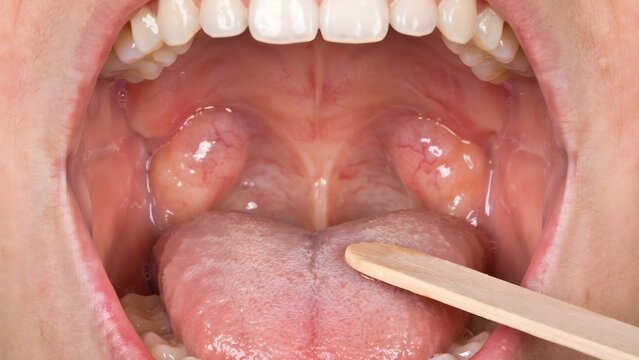Close-up view of inflamed tonsils and uvula inside a human mouth, indicating a sore throat or infection.