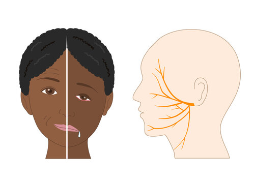 Facial Asymmetry and Facial Nerve Pathway in Facial Nerve Palsy &ndash; Anatomical Illustration