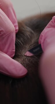Top view Scalp microblade procedure hair clinic closeup for medical treatment.