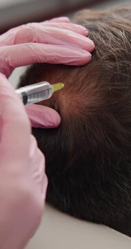 Closeup scalp injection hair restoration treatment for men in clinic for medical trichologist.