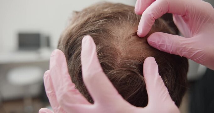 Trichologist dermatologist crown scalp inspection by clinician wearing gloves at hair clinic for male with alopecia thinning hair assessment and follicle evaluation.