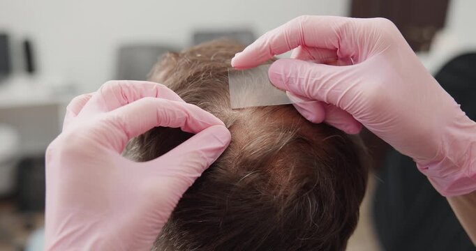Trichologist and client, Scalp examination closeup with glass slide and pink gloves for hair clinic, concept men with alopecia.