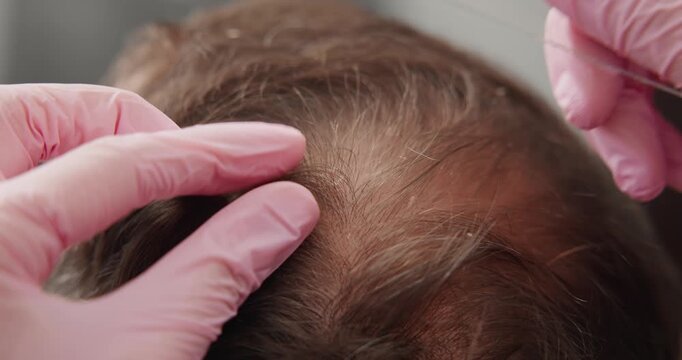 Dermatologist inspection skin of head. Trichologist and client, Scalp examination closeup with glass slide and pink gloves for hair clinic.