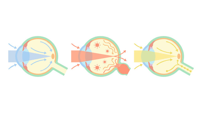 Medical illustration of human eye cross section showing healthy vision, refractive errors, myopia, hyperopia, ophthalmic diagnosis and treatment