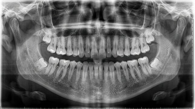 Panoramic Dental X-ray Shows Full Mouth Details Of Teeth And Jawbone Anatomy