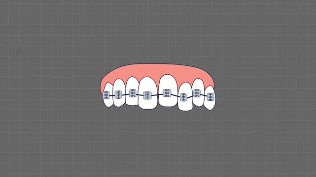 Flat Design Animation of Crooked Teeth Straightening With Orthodontic Braces Animation. Gradually Move Into A Straight,  Demonstrating Dental Alignment and Treatment Process.