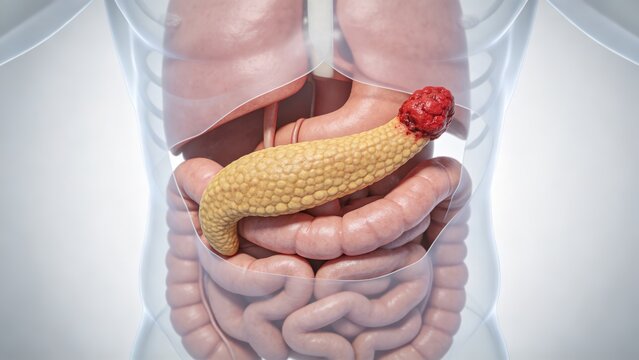 Pancreatic Cancer: Malignant Tumor Lesion of Human Pancreas, 3D Medical Anatomical Illustration of Digestive Gland Organ