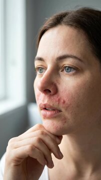 Epidermal discomfort portrait: Staphylococcus impact, skin condition, facial redness, dermal irritation, unwell woman, health concern, pustule presence, pathogen spread.
