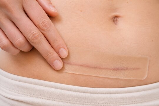 Woman applying silicone gel sheet to abdominal surgical scar
