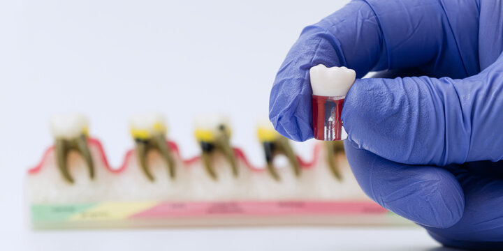 Dental Crown Restoration Concept with Blurred Tooth Decay Model
