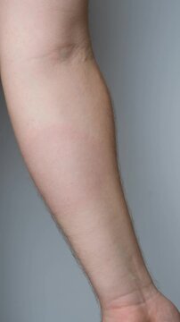 Erythema migrans rash on human skin caused by Lyme disease from a tick bite