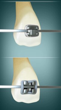 3D animation showing differences between Self-ligating braces and traditional braces.