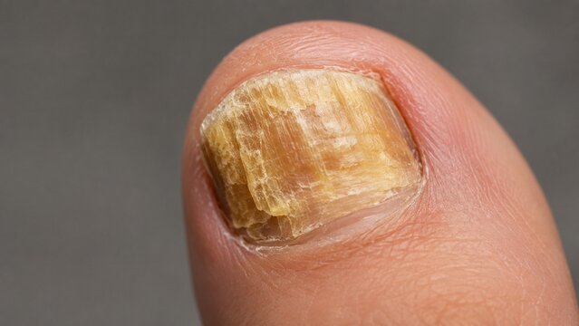 Macro Close-up of Toenail Fungus Onychomycosis Infection with Yellowing Thickened and Brittle Texture